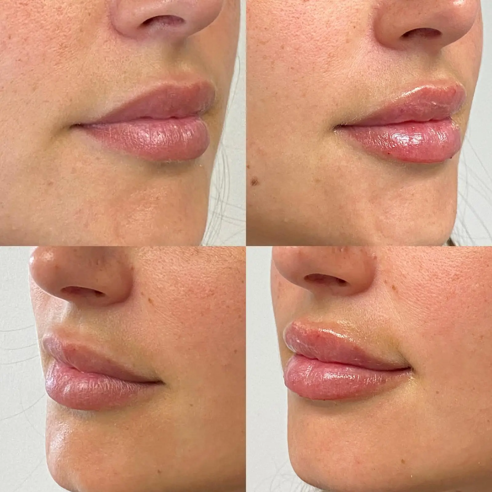 Armonización de Labios femenino - Bioestimulación